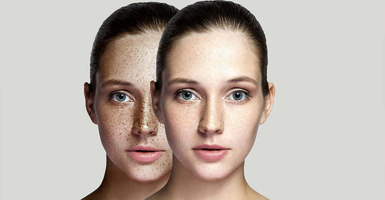 درمان لکه های تیره پوست